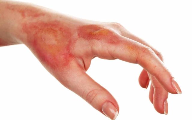 Work Injury Lawyer in Scranton, PA: What to Do If You’re Hurt at Work